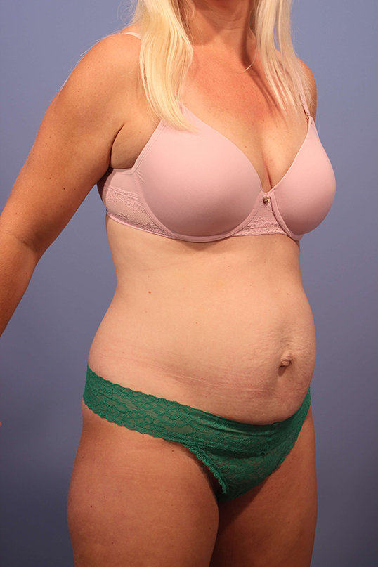 Tummy Tuck before and after - before
