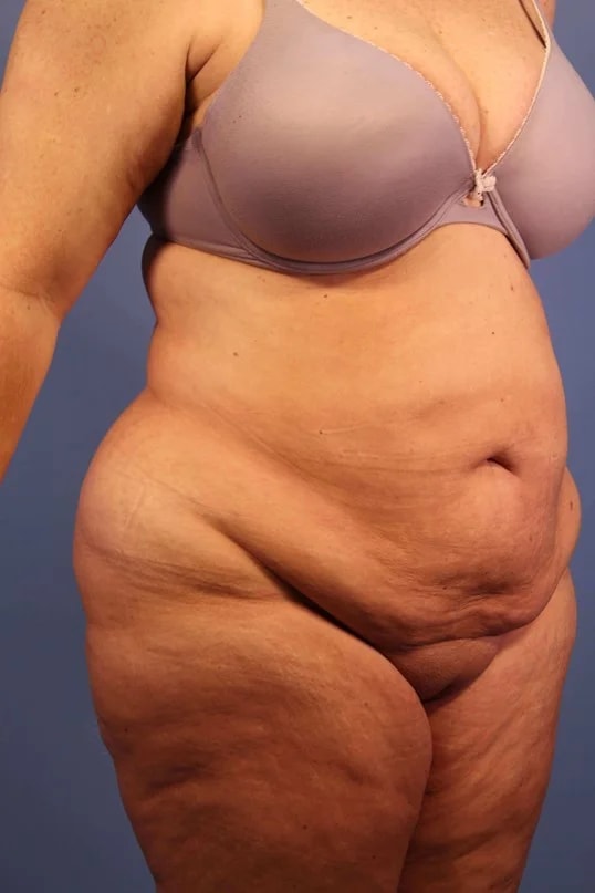 Tummy Tuck before and after - before