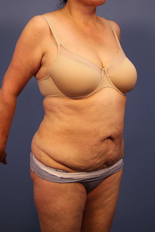 Tummy Tuck before and after - before