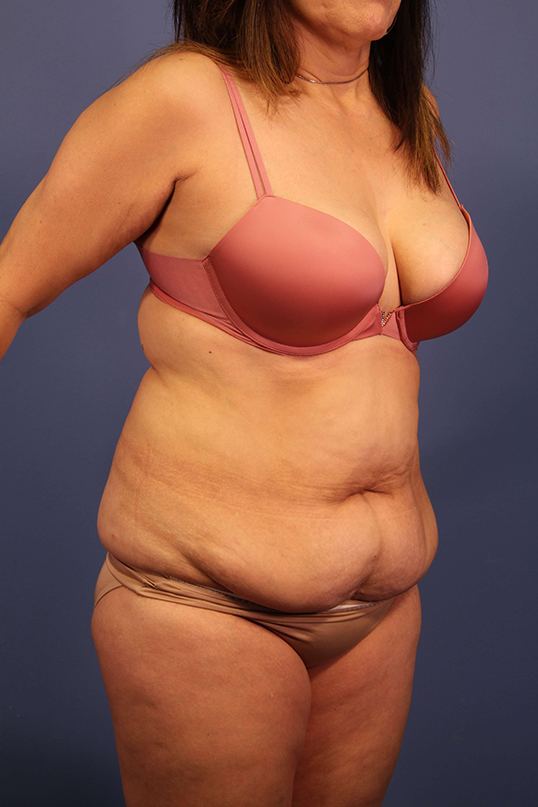 Tummy Tuck before and after - before