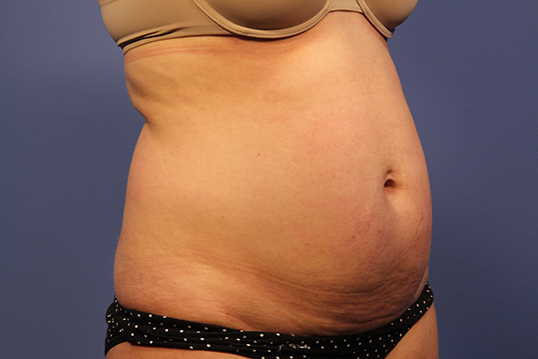 Tummy Tuck before and after - before