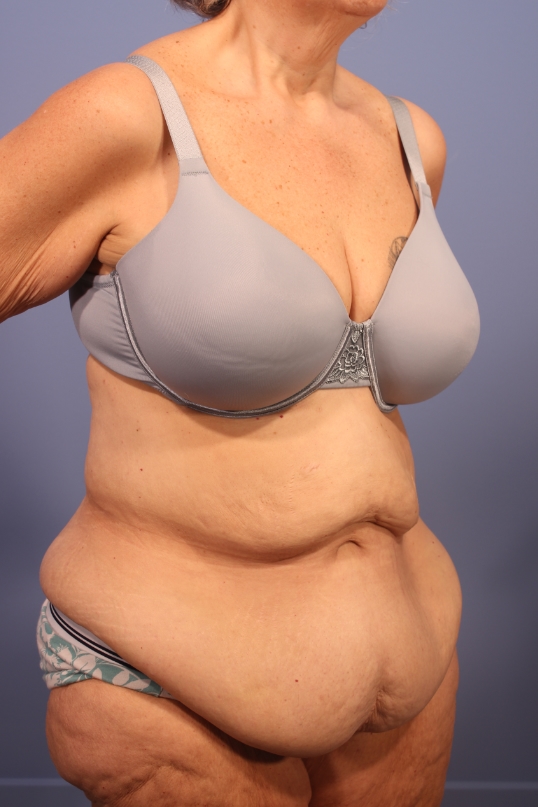 Tummy Tuck before and after - before