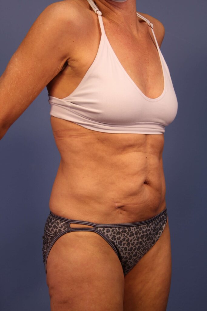 Tummy Tuck before and after - before
