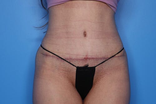 Liposuction before and after - after