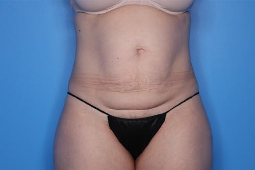 Liposuction before and after - before