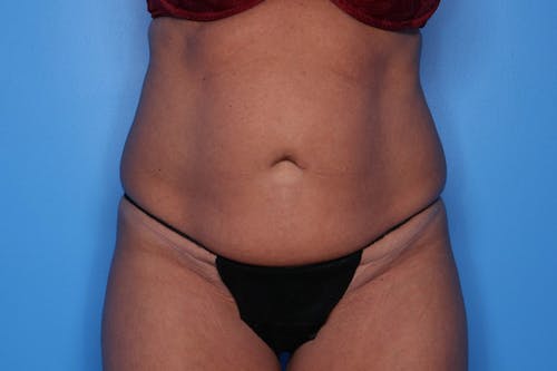 Tummy Tuck before and after - before
