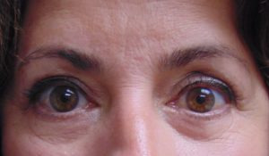 Blepharoplasty before and after - after