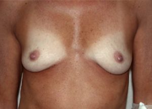 Breast Augmentation before and after - before