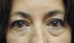 Blepharoplasty before and after - before