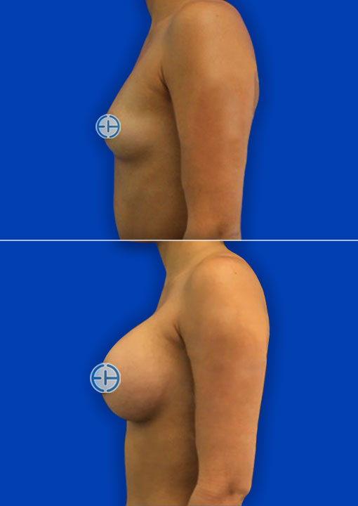 Breast Augmentation before and after - after