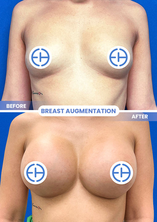 Breast Augmentation before and after - after