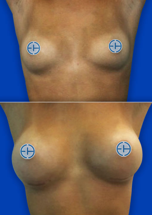 Breast Augmentation before and after - after