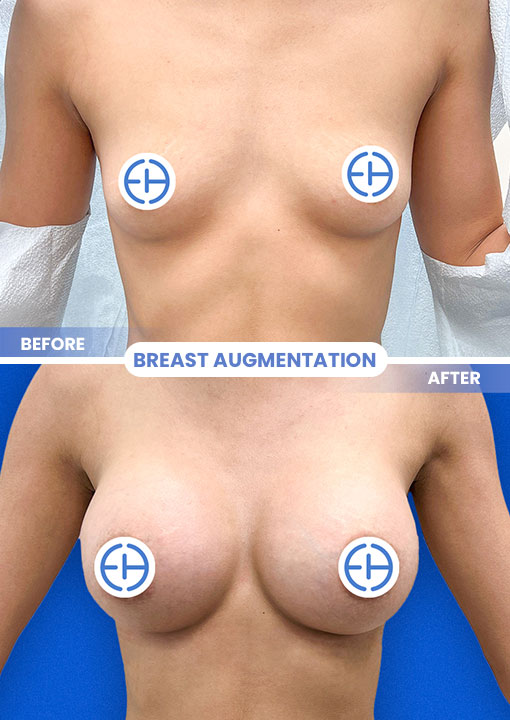Breast Augmentation before and after - after