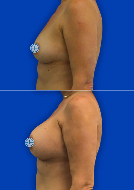 Breast Augmentation before and after - after