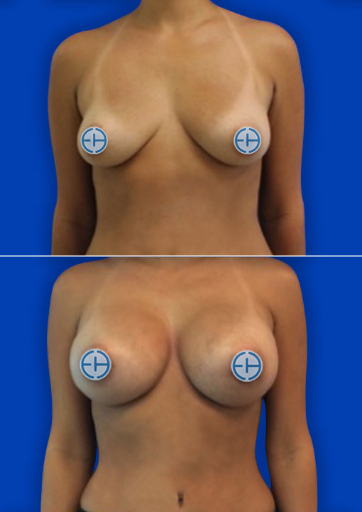 Breast Augmentation before and after - after