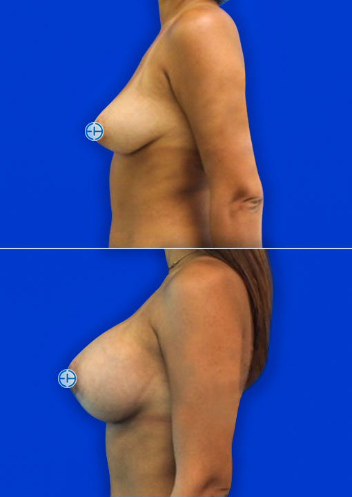 Breast Augmentation before and after - after