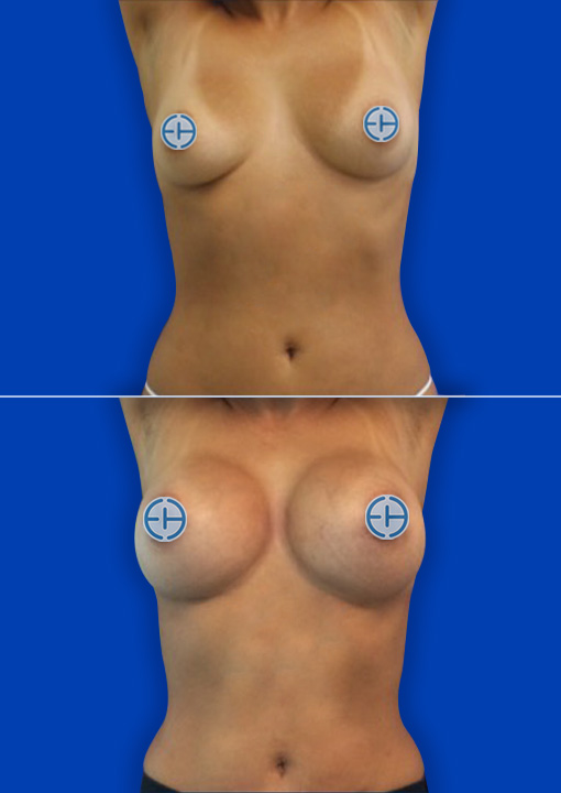 Breast Augmentation before and after - after