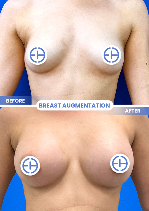 Breast Augmentation before and after - before