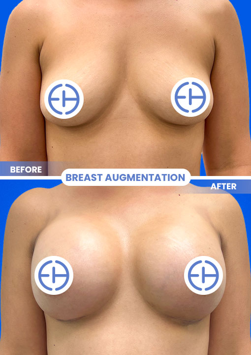Breast Augmentation before and after - before