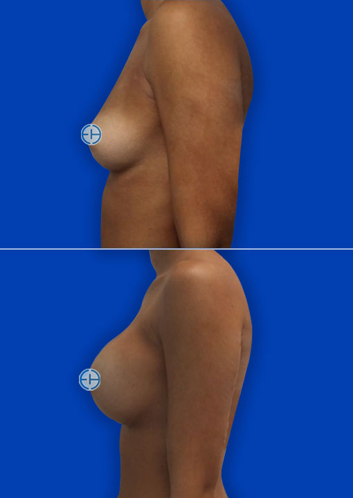 Breast Augmentation before and after - before