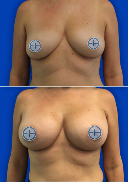 Breast Augmentation before and after - before