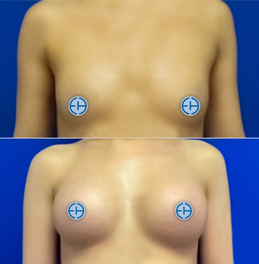 Breast Augmentation before and after - before