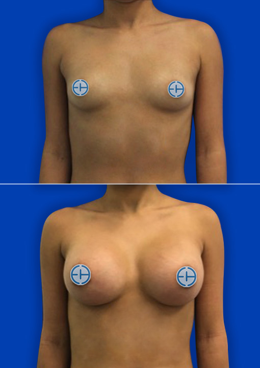 Breast Augmentation before and after - before