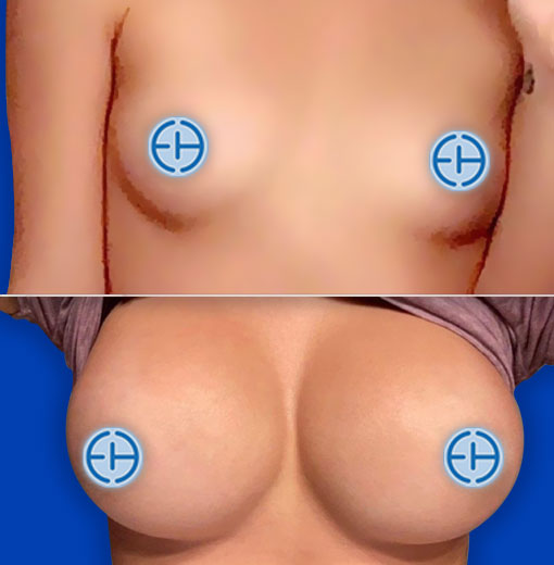 Breast Augmentation before and after - before