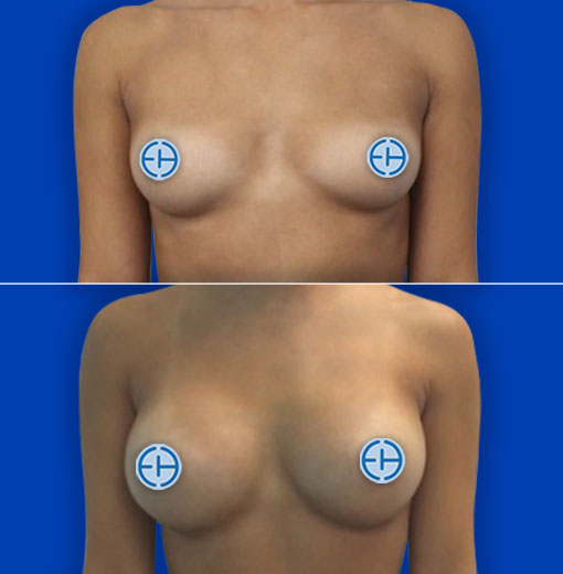 Breast Augmentation before and after - before