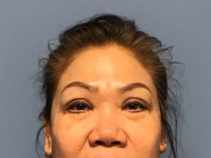 Asian Eyelid Surgery before and after - after