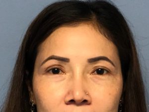 Asian Eyelid Surgery before and after - after