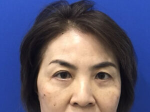 Asian Eyelid Surgery before and after - after