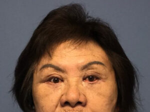Asian Eyelid Surgery before and after - after