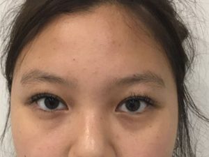 Asian Eyelid Surgery before and after - after