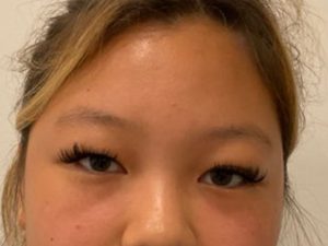 Asian Eyelid Surgery before and after - before
