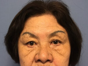 Asian Eyelid Surgery before and after - before