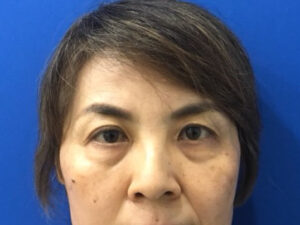 Asian Eyelid Surgery before and after - before