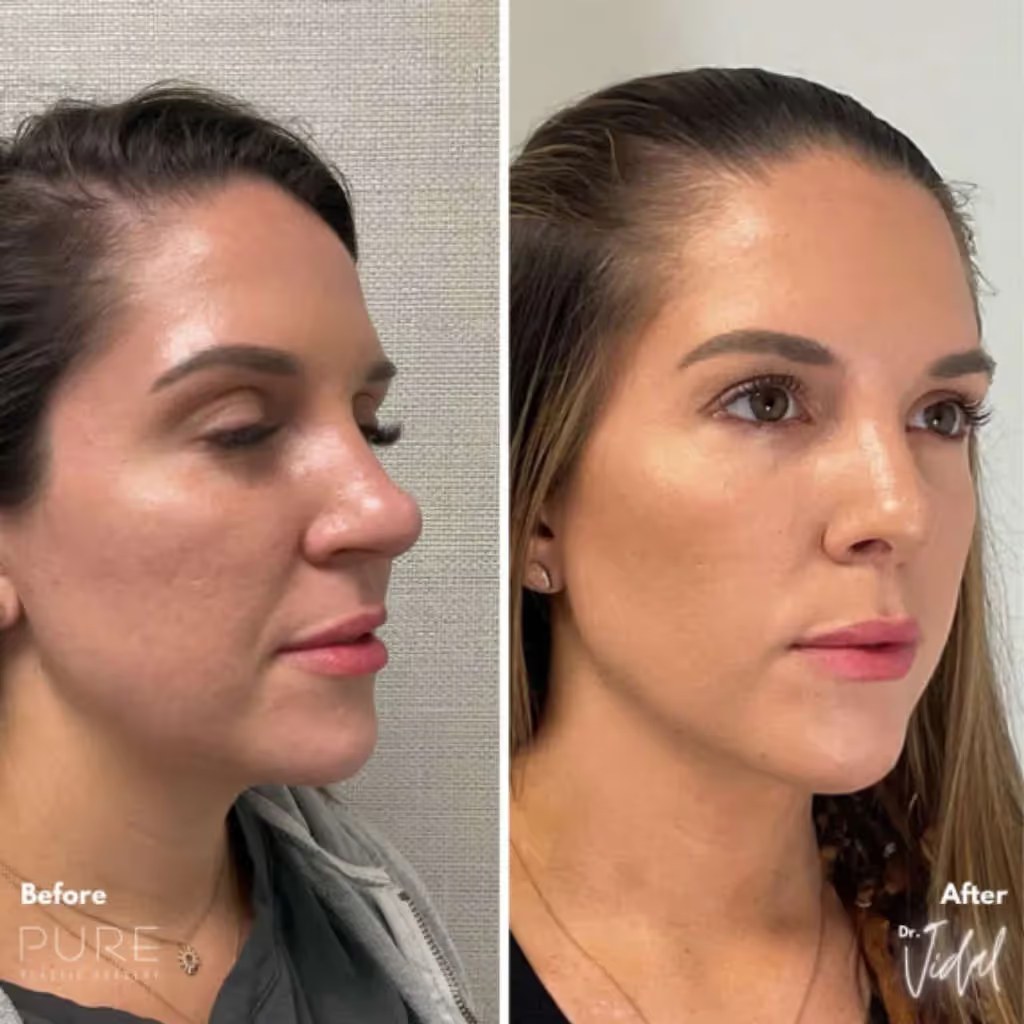 Rhinoplasty before and after - after