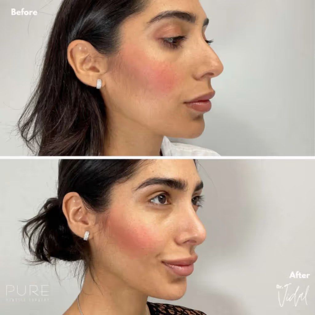 Facetite before and after - after
