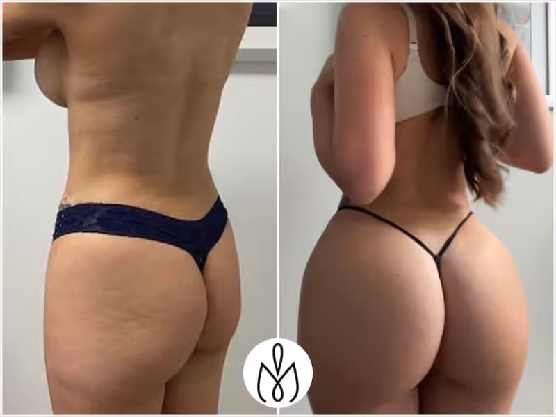 Rhinoplasty before and after - after
