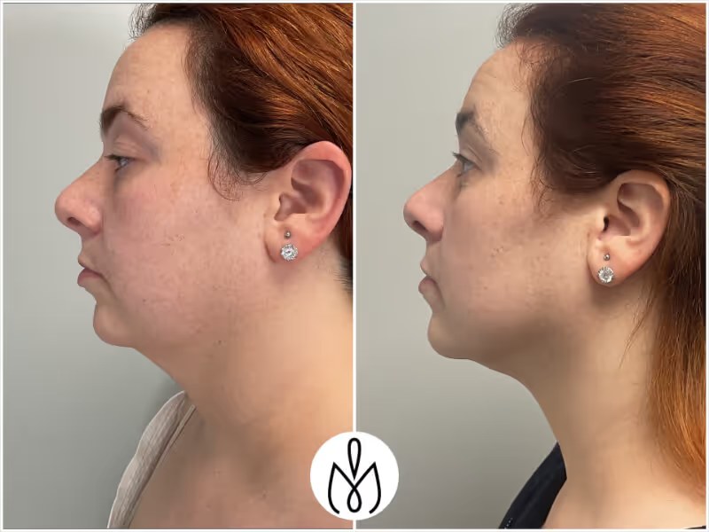Facetite before and after - before