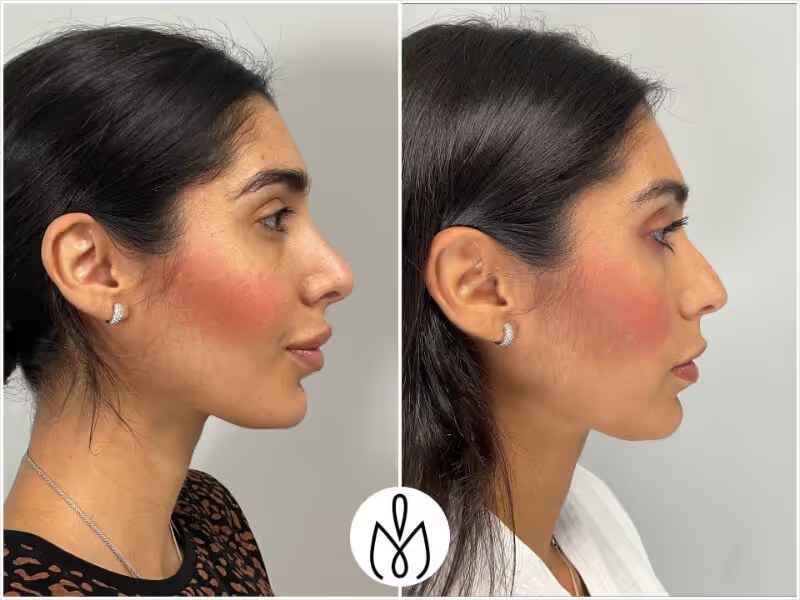 Rhinoplasty before and after - before