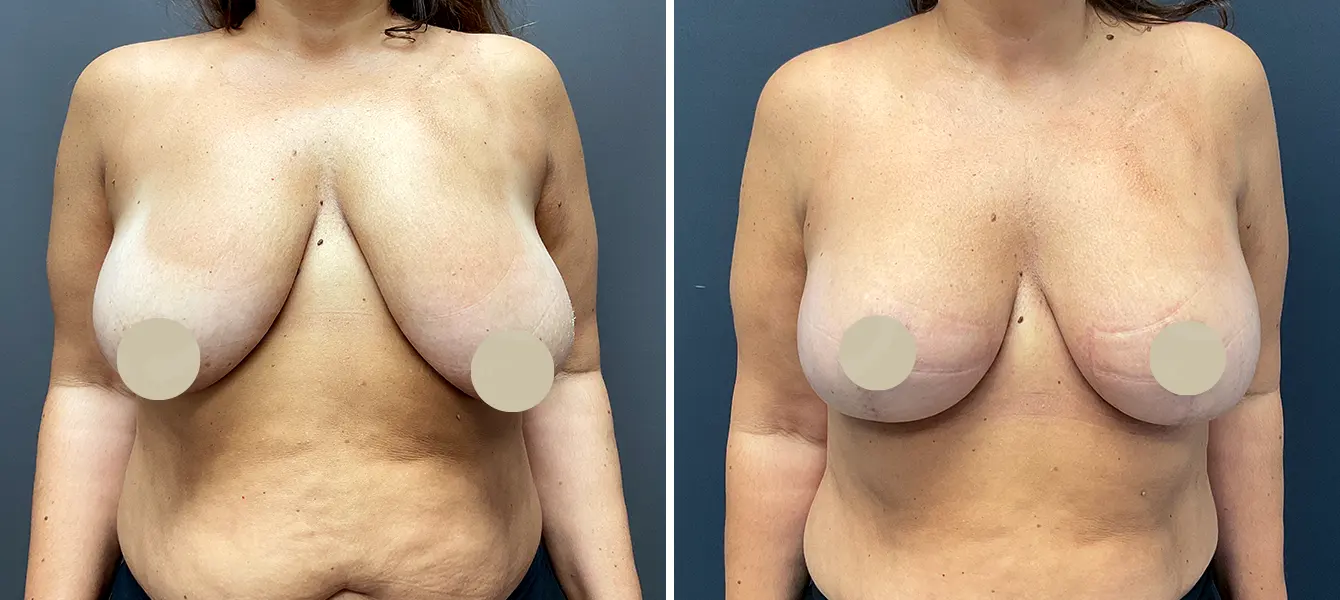Breast Lift (Mastopexy) before and after - after