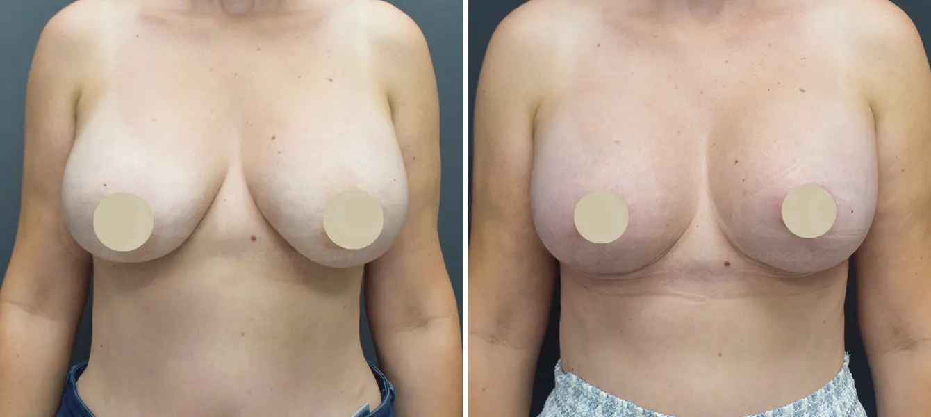 Breast Lift (Mastopexy) before and after - after
