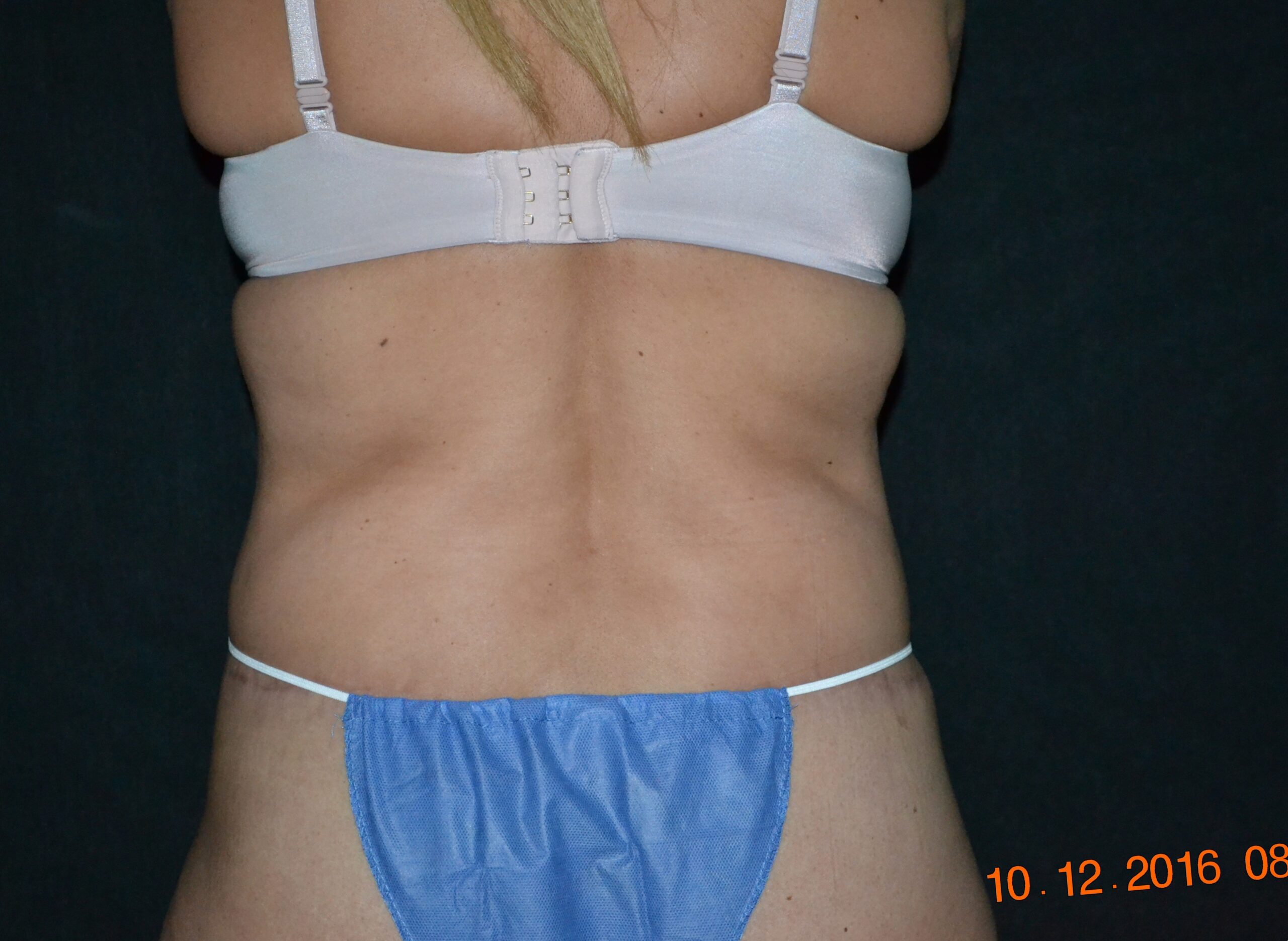 Back Skin Excision, Liposuction, and Fat Grafting to Buttocks before and after - after