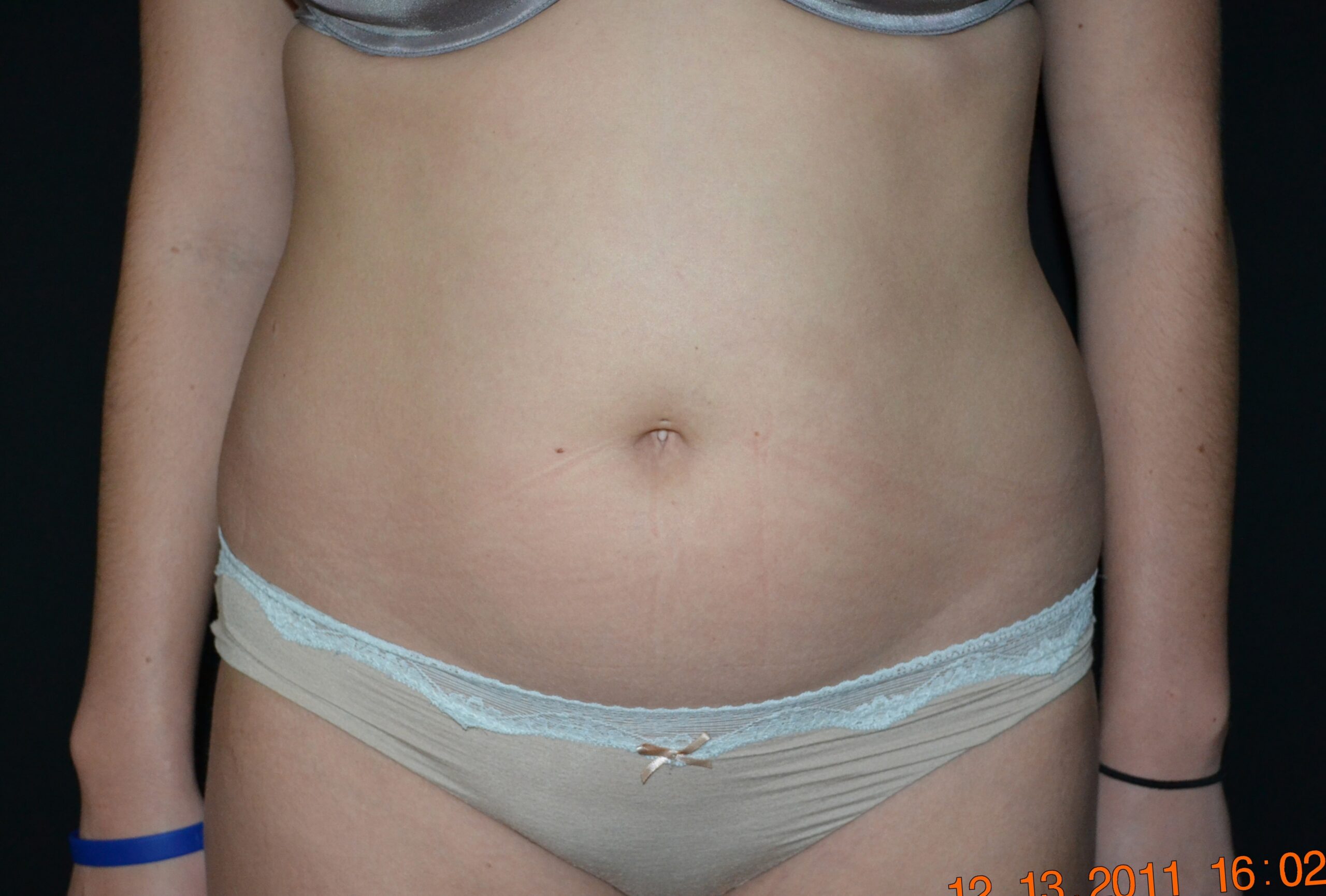 Liposuction before and after - before