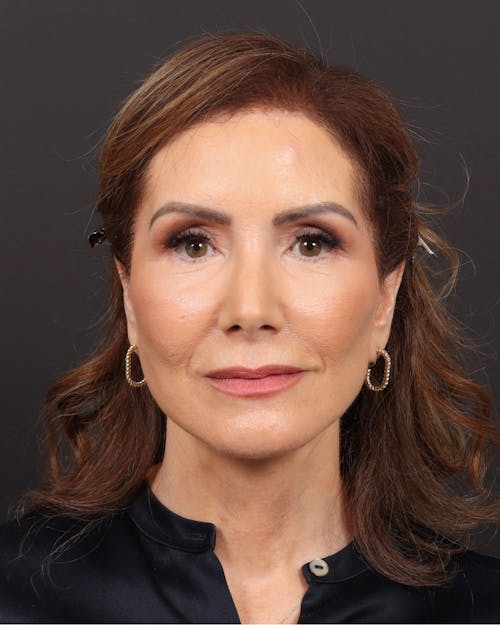 Facelift before and after - after