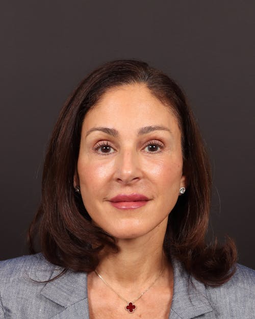 Facelift before and after - after