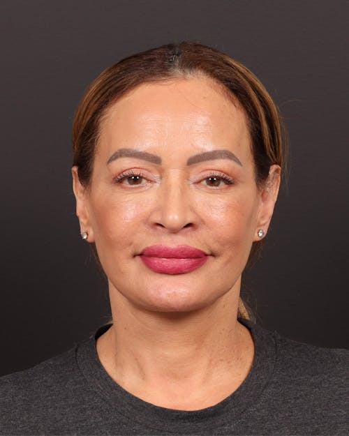 Facelift before and after - after
