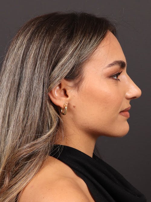 Rhinoplasty before and after - after